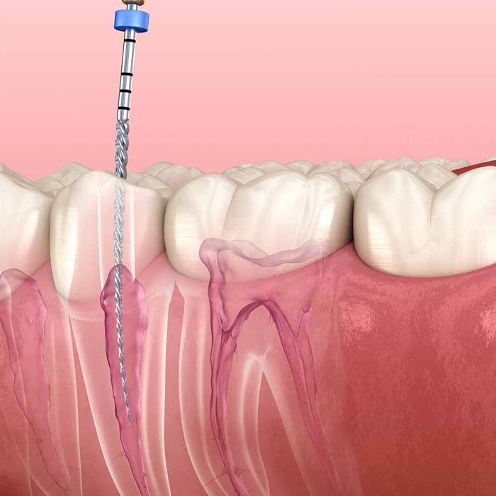 Endodontics-3