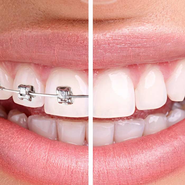 Orthodontics in Tijuana