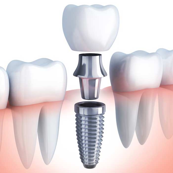 Single Dental Implant