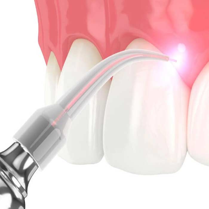 laser-Endodontics