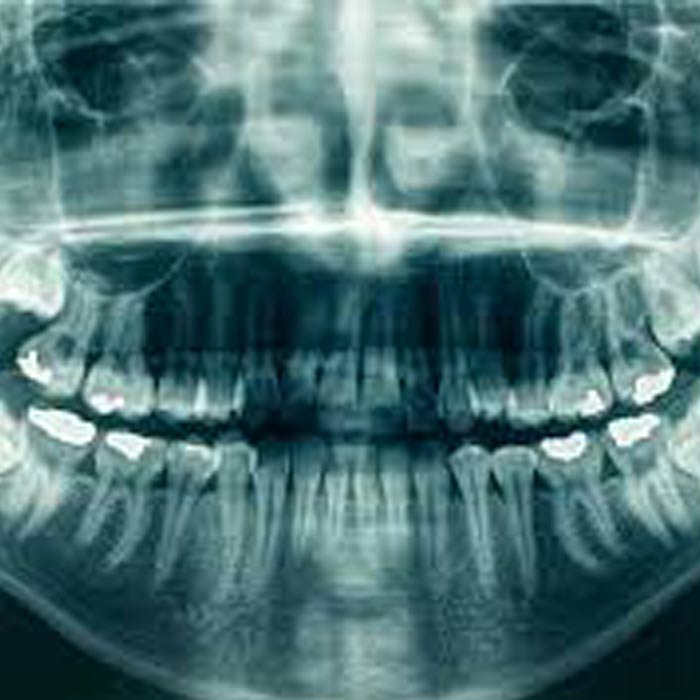 Dental implant in tijuana