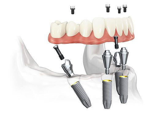 All on 4 Implant Tijuana