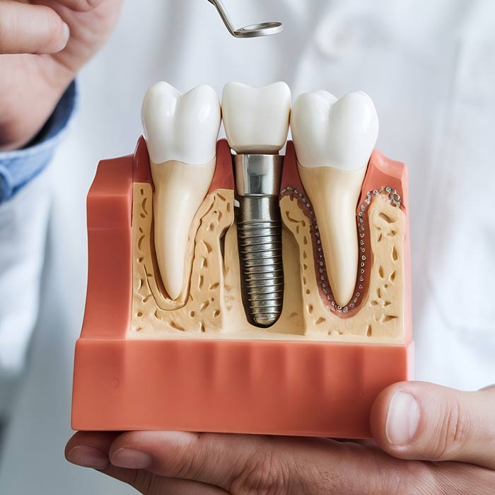 Dental Implants in tijuana