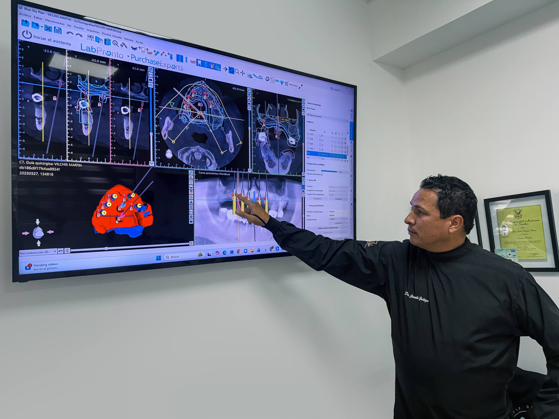 All on 4 implants tijuana