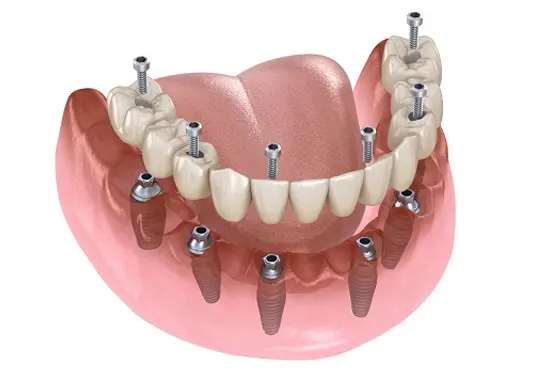 All-on-6-dental-implants-tijuana