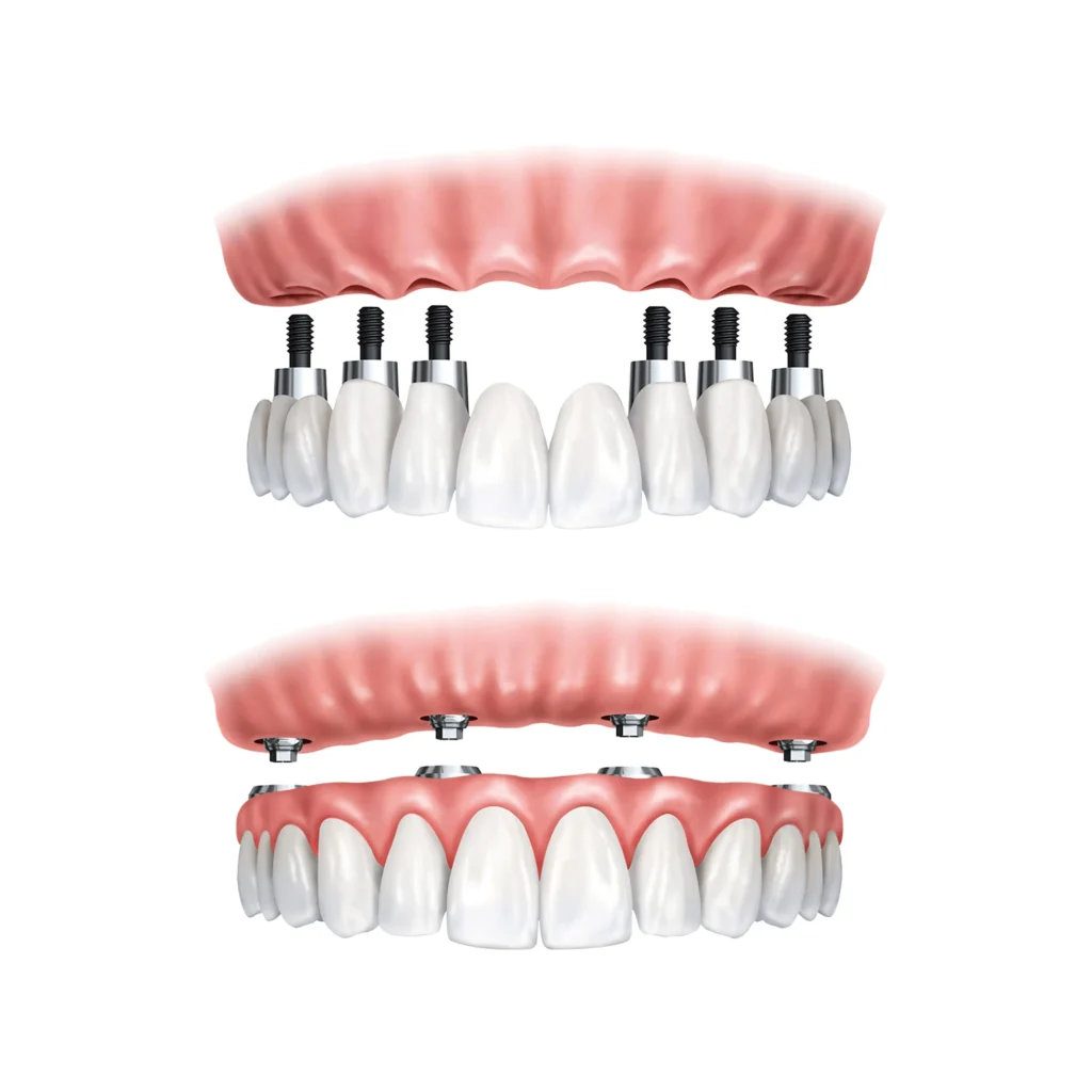 All on 6 Dental Implants in Tijuana Mexico