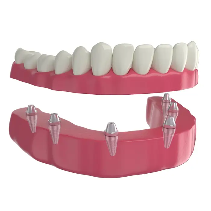 all on 6 dental implants in tijuana